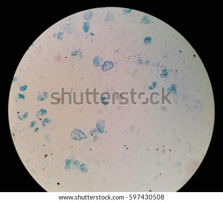 Under 100X light microscope, red dye Acid-Fast Bacilli (AFB) bacteria observed on this smear. ABF smear is used to detect mycobacteria that may be causing an infection such as tuberculosis (TB). 
