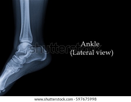 Film x-ray ankle (Lateral view) : show human's ankle.