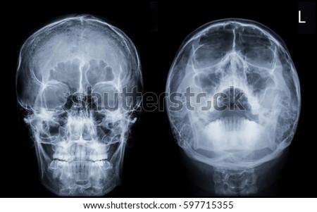 Film x-ray Skull / PNS (Caldwell , Water's view) : show normal human's skull / PNS