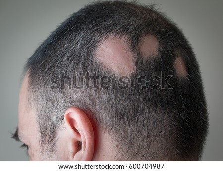 Alopecia Aerata - Spot Baldness Royalty-Free Stock Photo #600704987