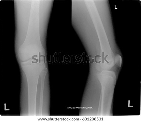knee tomography