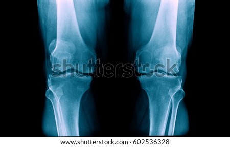 x-ray knee joint degenerative change