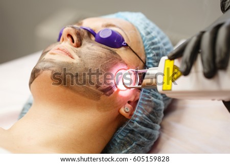 Carbon face peeling. Laser pulses clean the skin of the face. Hardware cosmetology. The process of photothermolysis, warming the skin. Facial skin rejuvenation. Royalty-Free Stock Photo #605159828