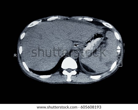 CT liver