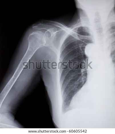 X-ray of human shoulder