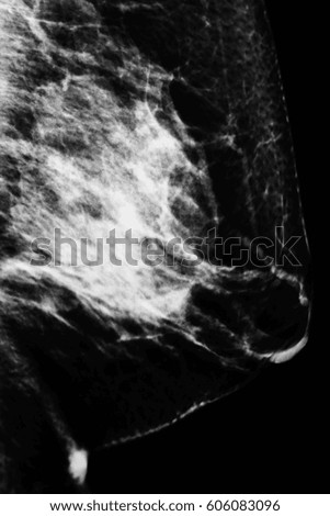 X ray film of chest and breast