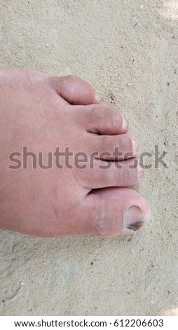 toes swelling closeup and nail fungus