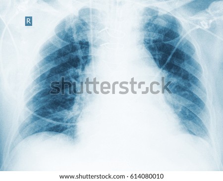 Radiological control of hypostatic pneumonia.