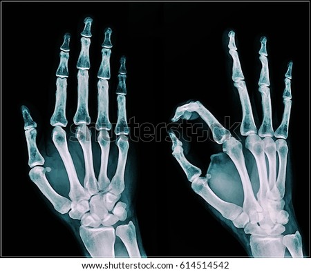 Film x-ray hand (AP , Oblique view : show human's hand.