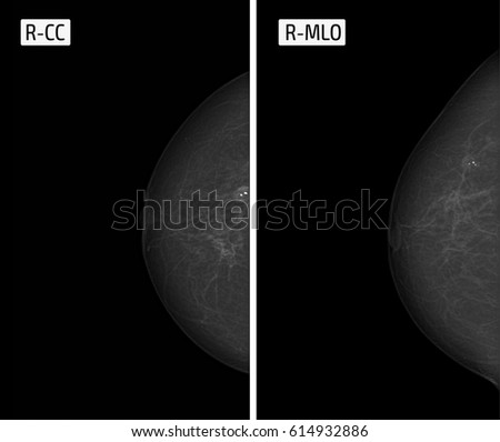 x-ray picture Mammography. Calcinates.