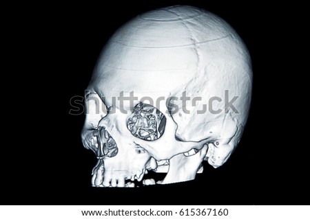 Skull picture in X-rays