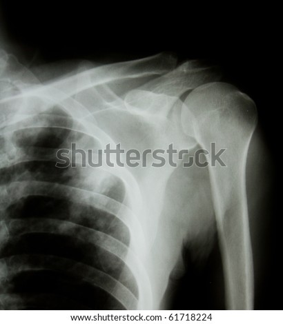 X-ray of human shoulder.