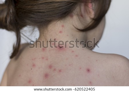 Varicella virus or Chickenpox bubble rash on child, baby or adult 
little girl with illness varicella close up
 Royalty-Free Stock Photo #620522405