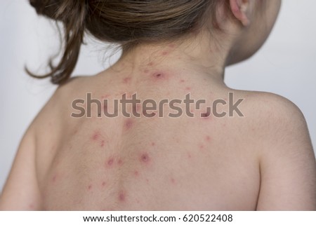 Varicella virus or Chickenpox bubble rash on child, baby or adult 
little girl with illness varicella Royalty-Free Stock Photo #620522408