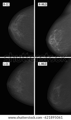 X-ray picture Mammography. Calcinates. Tumor.