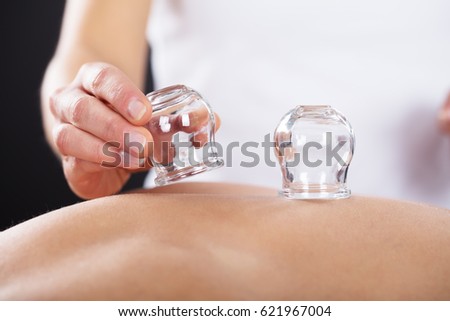 Close-up Of A Therapist Giving Cupping Treatment On Back Royalty-Free Stock Photo #621967004