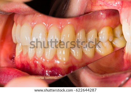 Healthy human denture made with special photography technique in dentist office.