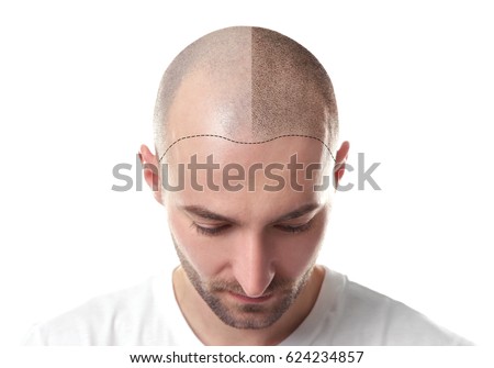 Man before and after hair loss treatment on white background Royalty-Free Stock Photo #624234857