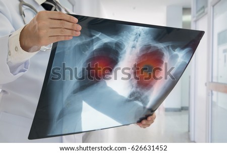 Lung Cancer or Pneumonia. Doctor check up x-ray image have problem lung tumor of patient. Royalty-Free Stock Photo #626631452