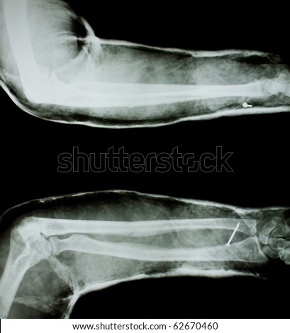 X-ray of human arm with arm splint.