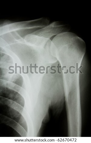 X-ray of human shoulder.
