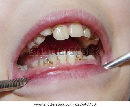 Close-Up of open mouth of a child with stained teeth, dental treatment at the dentist.