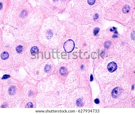 Nuclear vacuolation/glycogenation is characteristic of non-alcoholic fatty liver disease (NAFLD). Vacuolated nuclei observed usually in periportal hepatocytes. Stained with H&E.  Royalty-Free Stock Photo #627934733