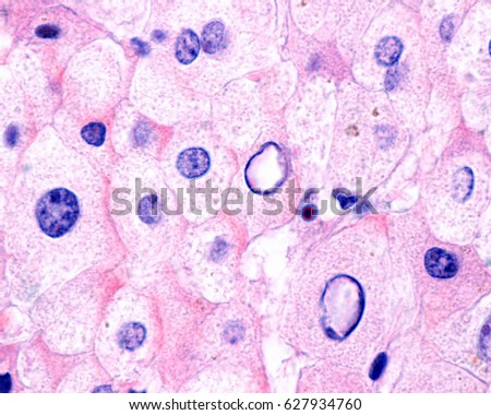 Nuclear vacuolation/glycogenation is a characteristic histological feature of non-alcoholic fatty liver disease (NAFLD). Stained with haematoxylin and eosin. Royalty-Free Stock Photo #627934760