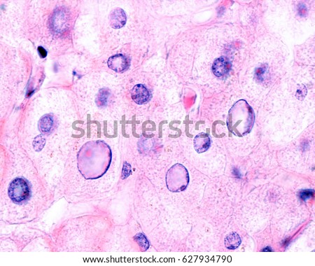 Nuclear vacuolation/glycogenation is a characteristic histological feature of non-alcoholic fatty liver disease (NAFLD). Vacuolated nuclei is observed usually in periportal hepatocytes. H&E stained.  Royalty-Free Stock Photo #627934790