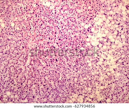 Light micrograph of a liver lobule with steatosis. Hepatocytes loaded with lipid droplets are located on the periphery of the hepatic lobule (more frequent in the pediatric NAFLD). H&E stained. Royalty-Free Stock Photo #627934856