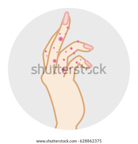 Hand Skin care Trouble ,Eczema Illustration -Side view