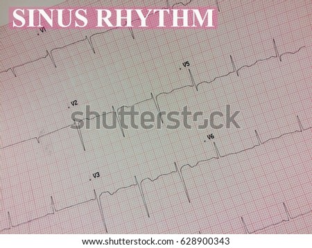 EKG sinus rhythm