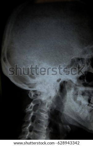 Film x-ray Skull lateral : show normal human's skull and cervical spine and blank area at right side