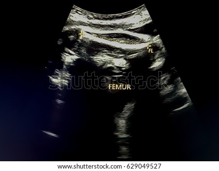 Fetal Femur on Ultrasound