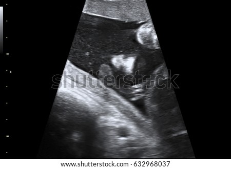 a Newborn baby in picture ultrasound