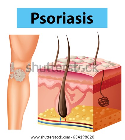 Diagram showing psoriasis on human skin illustration