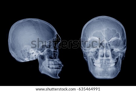  Very good quality X-ray image of normal human skull front (AP) view and side (Lateral) view, Process in blue tone isolated on black background.