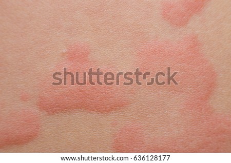 Close up Allergy rash, Around Back view of human with dermatitis problem of rash ,Allergy rash and Health problem. Royalty-Free Stock Photo #636128177