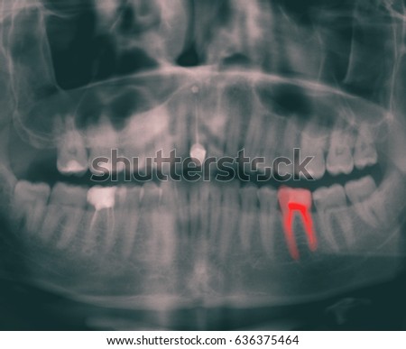 tomography of human jaw ( jowl ) with pain in teeth.  monochromatic picture with colored  tooth . health and medicine background.