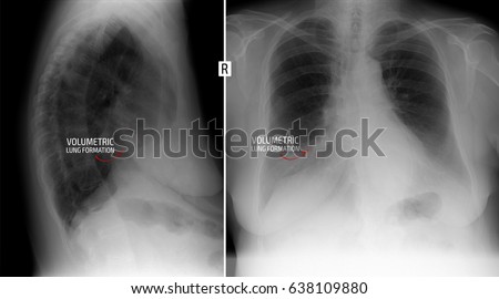 X-ray lung. Shows volume formation of the right lung. Marker. 
