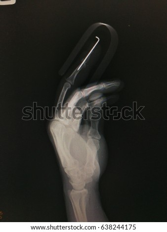 X-ray film hand