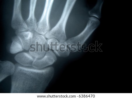 x-ray picture of the wrist of hand