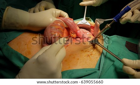 Constricting Sigmoid Colon Tumour Royalty-Free Stock Photo #639055660
