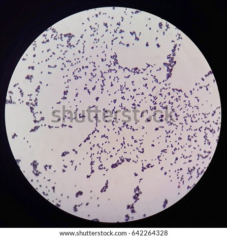 Smear of Gram's stained with gram positive cocci bacteria under 100X light microscope.