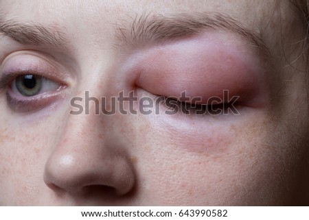 Young woman with allergic reaction Royalty-Free Stock Photo #643990582
