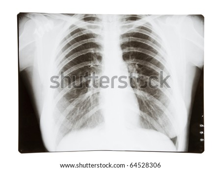X-ray picture of lungs