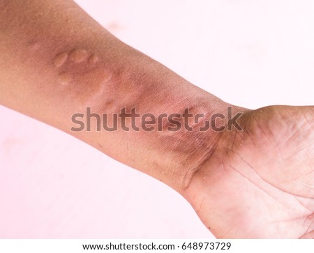 Skin Allergy Symptoms of patient Royalty-Free Stock Photo #648973729