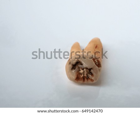 Real decayed tooth.