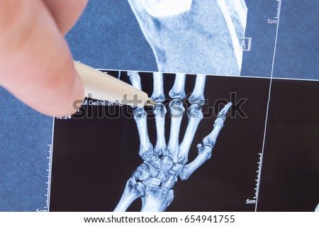 X-ray scan of hand, bones and finger joints. Doctor pointed on finger small joints, where pathology is detected, such as arthritis, rheumatoid,fracture. Diagnosis of joint diseases by radiology 