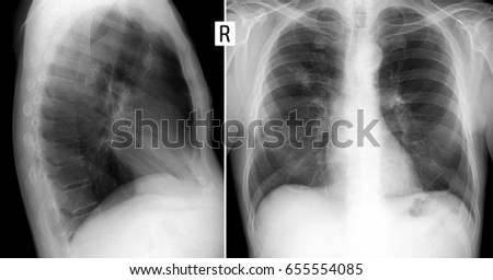 x-ray lungs: Abscess of right lung.